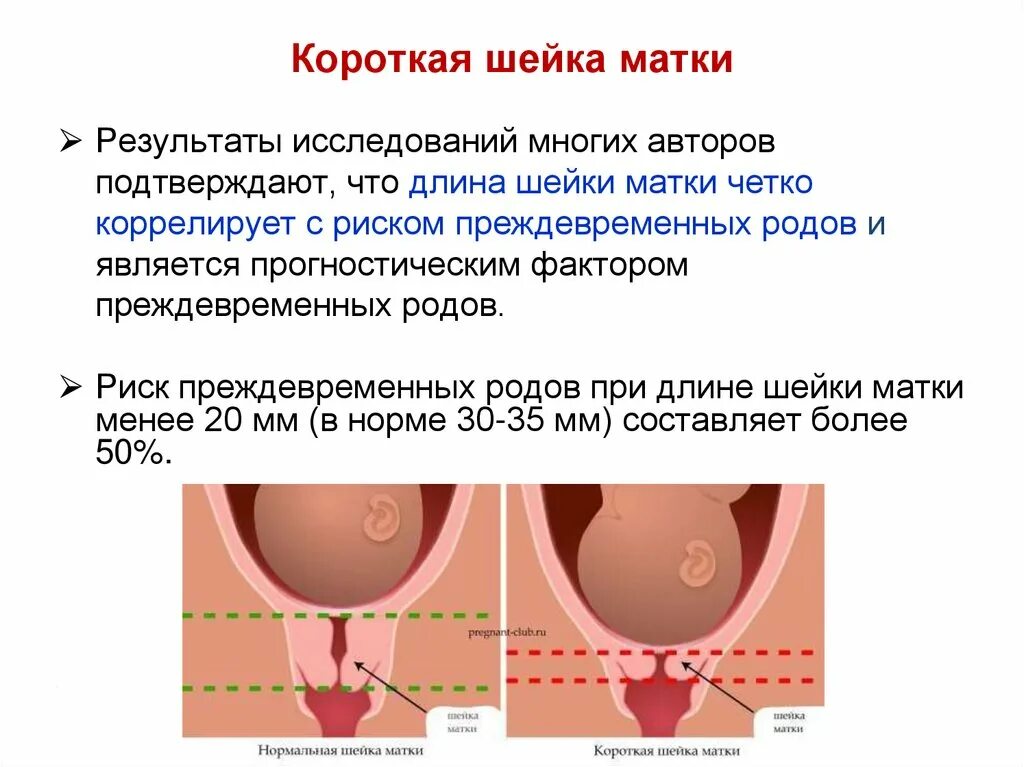 Почему укорачивается шейка матки при беременности. Шейка укоротилась при беременности. Укорочение шейки при беременности на ранних сроках. Беременность шейка 3