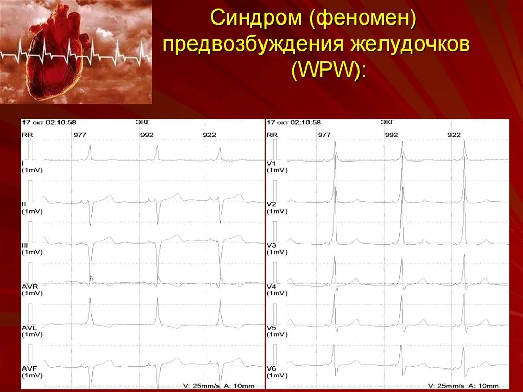 Синдром феномена. Феномен wpw на экг. впв феномен и впв синдром. феномен предвозбуждения желудочков wpw. синдром предвозбуждения желудочков клинические рекомендации.