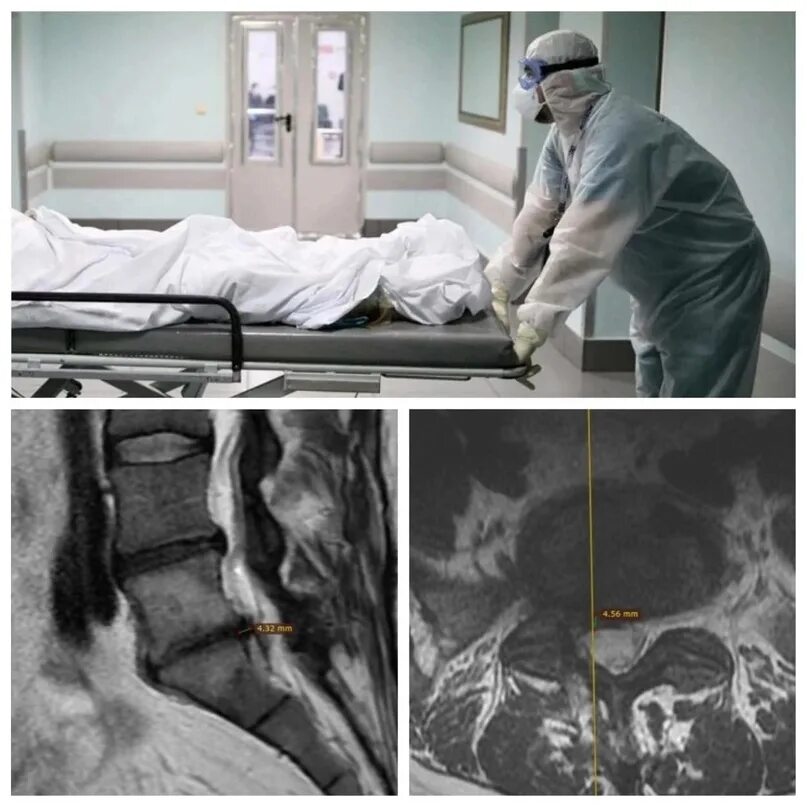 Операция в 90 лет. Операция по умеше спины. Фото с местаевррнимус после смерти. Фото после операции лорда. Что удаляют после смерти.