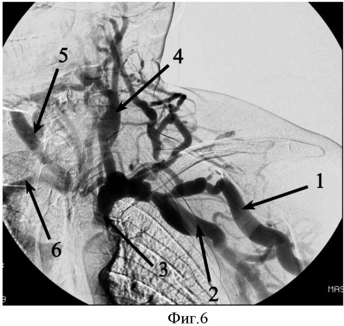 Ангиодистония сосудов. Артериовенозная фистула позвоночной артерии. Артериовенозная фистула в головном мозге. Артериовенозный шунт головного мозга. Артериовенозная мальформация яремной вены.
