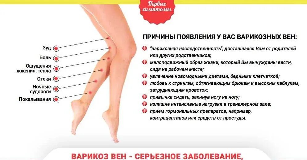 Варикозное расширение вен причины