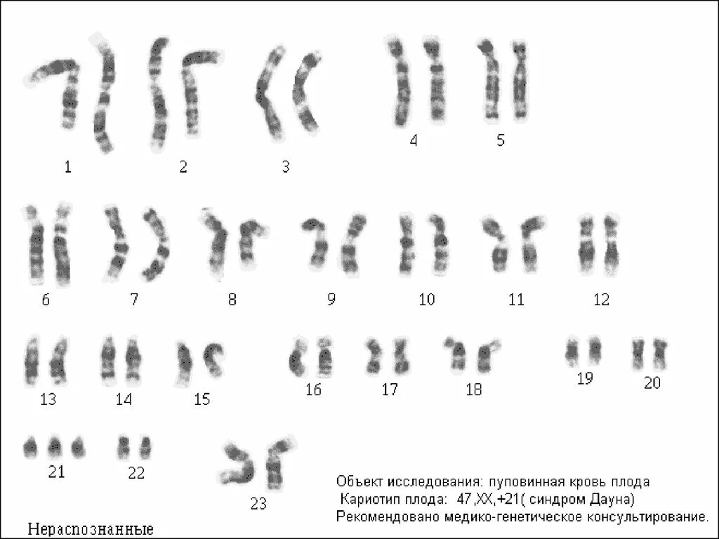 Удвоение хромосом какая мутация. Болезнь Дауна кариотип. Кариотип человека с болезнью Дауна. Варианты кариотипа при синдроме Дауна. Кариотип человека с синдромом Дауна.
