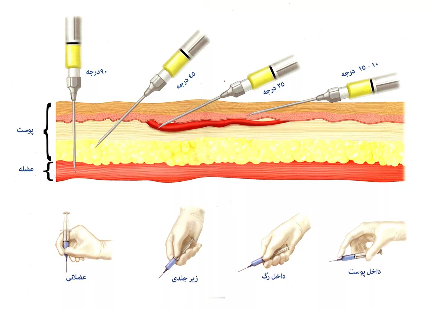 Внутрикожная инъекция угол введения иглы. Внутривенная инъекция глубина введения иглы. Угол введения иглы при внутривенном введении. Угол введения иглы при внутрикожной инъекции.
