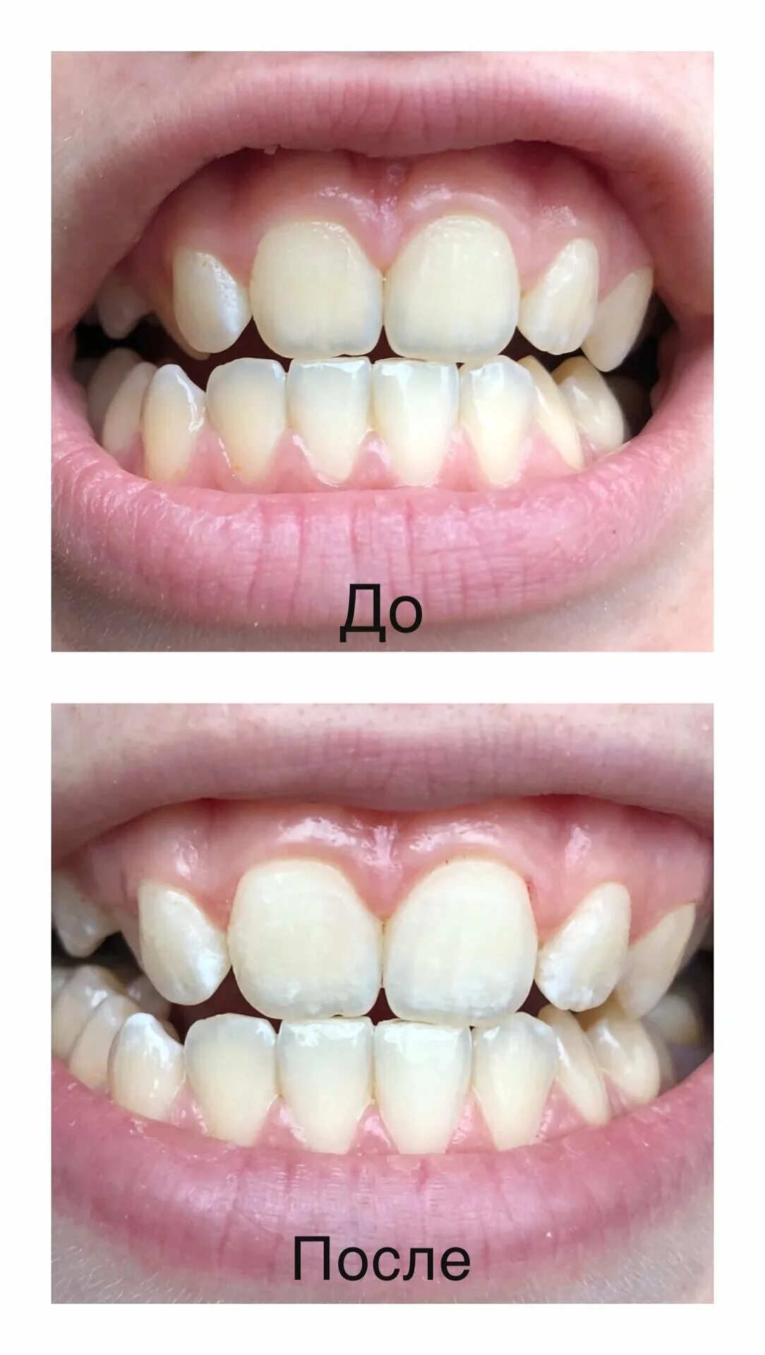 наритаки для отбеленных зубов. отбеливание зубов бриллиант. Mu brilliant smile. набор для отбеливания зубов май бриллиант смайл. косметическое отбеливание зубов реклама.