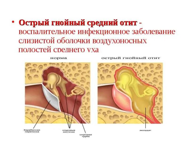 Острый Гнойный перфоративный средний отит у ребенка. Двухсторонний острый Гнойный средний отит перфоративная стадия. Гнойный бактериальный отит. Туботимпанальный Гнойный отит.