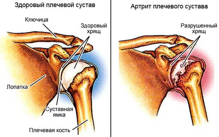 Эффективное лечение плечевого сустава. Реверсивный эндопротез плечевого сустава. Артрит плечевого сустава. Артроз плечевого сустава.
