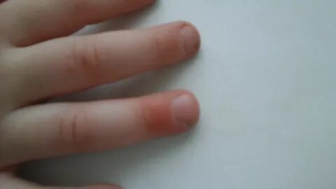 Болит палец у ребенка