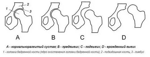 Классификация тазобедренного сустава