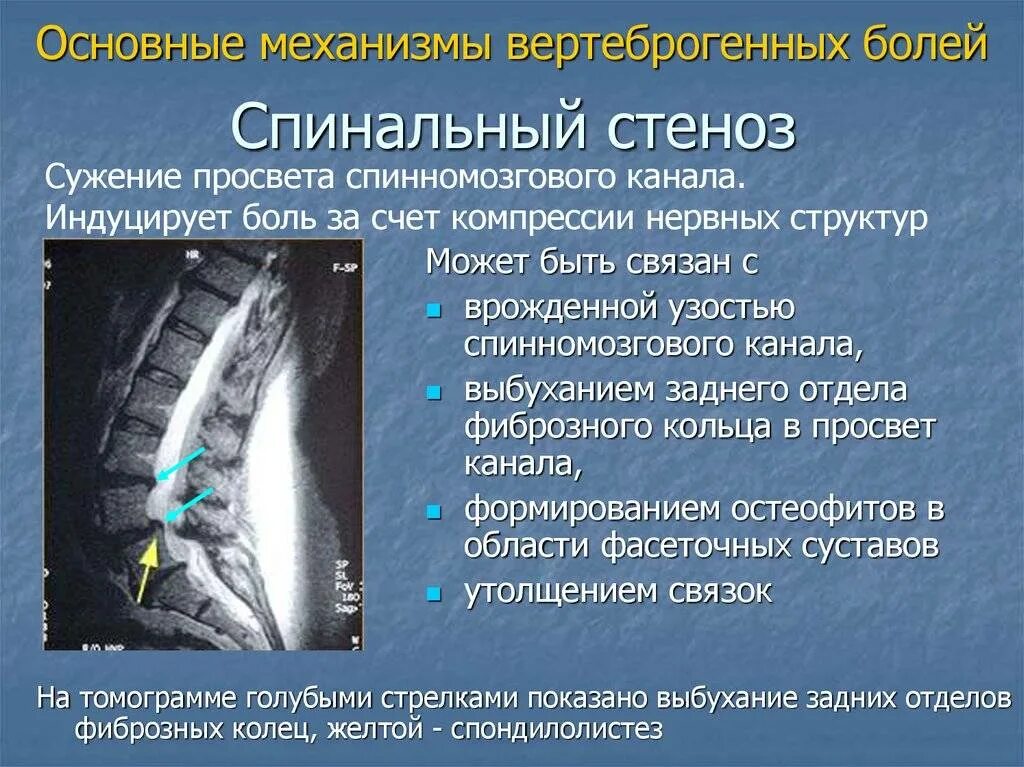 Стеноз инвалидность. Стеноз позвоночного канала l2-l3. Абсолютный стеноз позвоночного канала на кт. Стеноза костного позвоночного канала. Степени стеноза позвоночного канала поясничного отдела мрт.