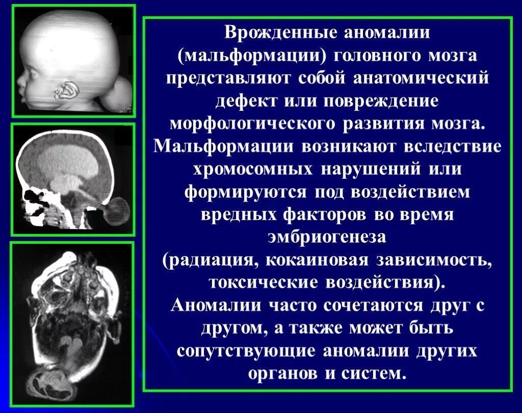 Аномалии развития головного. Пороки развития головного мозга. Врожденные аномалии развития головного мозга. Пороки развития головного мозга у плода. Нарушение развития головного мозга