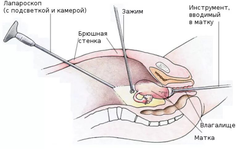 Лапароскопия трубы при внематочной. Лапароскопия гинекологические операции. Лапароскопия эндометриоидной кисты. Лапароскопия резекция яичника. Задний свод матки