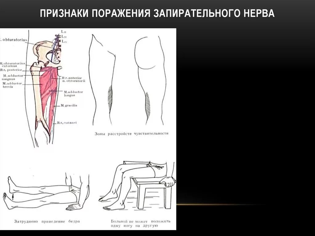 Синдром поражения запирательного нерва. Кожная ветвь запирательного нерва. Симптом поражения бедренного запирательного седалищного нерва. Запирательный нерв иннервация. Невропатия наружная бедра