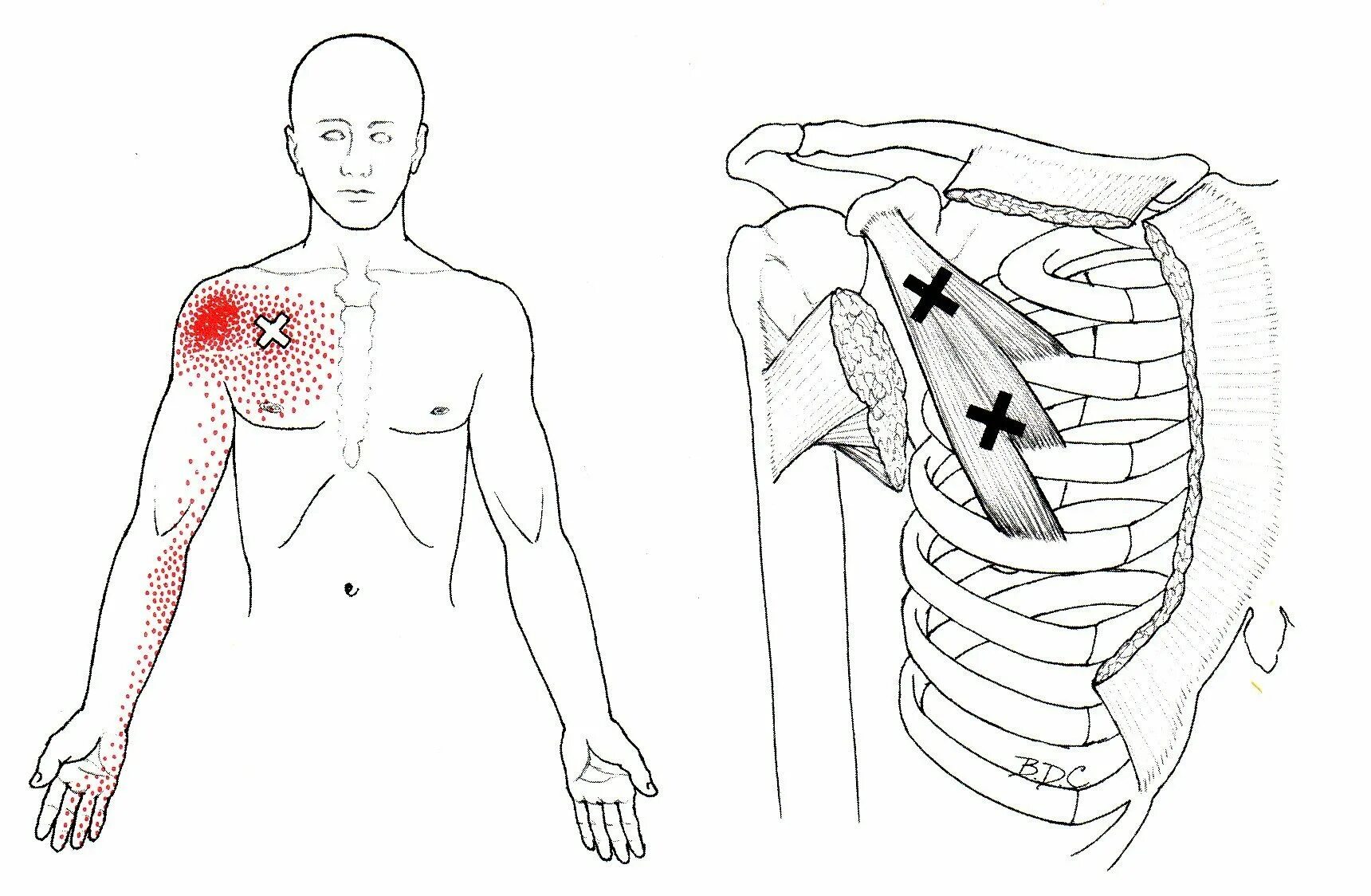 Триггерные точки малой грудной мышцы. Триггерные точки в грудной мышце. Триггерные точки большой грудной мышцы. Триггерные точки в малой грудной.