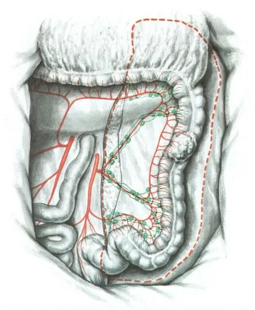 Синтопия сигмовидной кишки. Сигмовидная колэктомия. Лимфоотток сигмовидной кишки. Извилистая сигмовидная кишка. Сигма кишечника