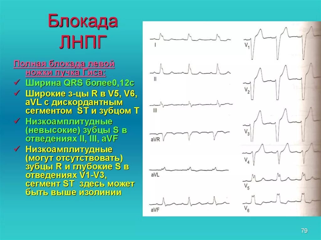 ЭКГ критерии блокады левой ножки пучка Гиса. Полная блокада левой ножки пучка Гиса. Признаки полной блокады ЛНПГ на ЭКГ. При блокаде левой ножки пучка Гиса зубец т. Левая ножка п гиса