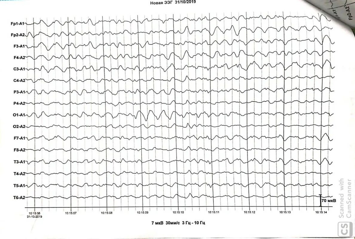 Ээг в новосибирске. Клиническая интерпретация ЭЭГ. Лямбда волны на ЭЭГ. ЭЭГ головного мозга в проекциях. Судороги на ЭЭГ У ребенка.
