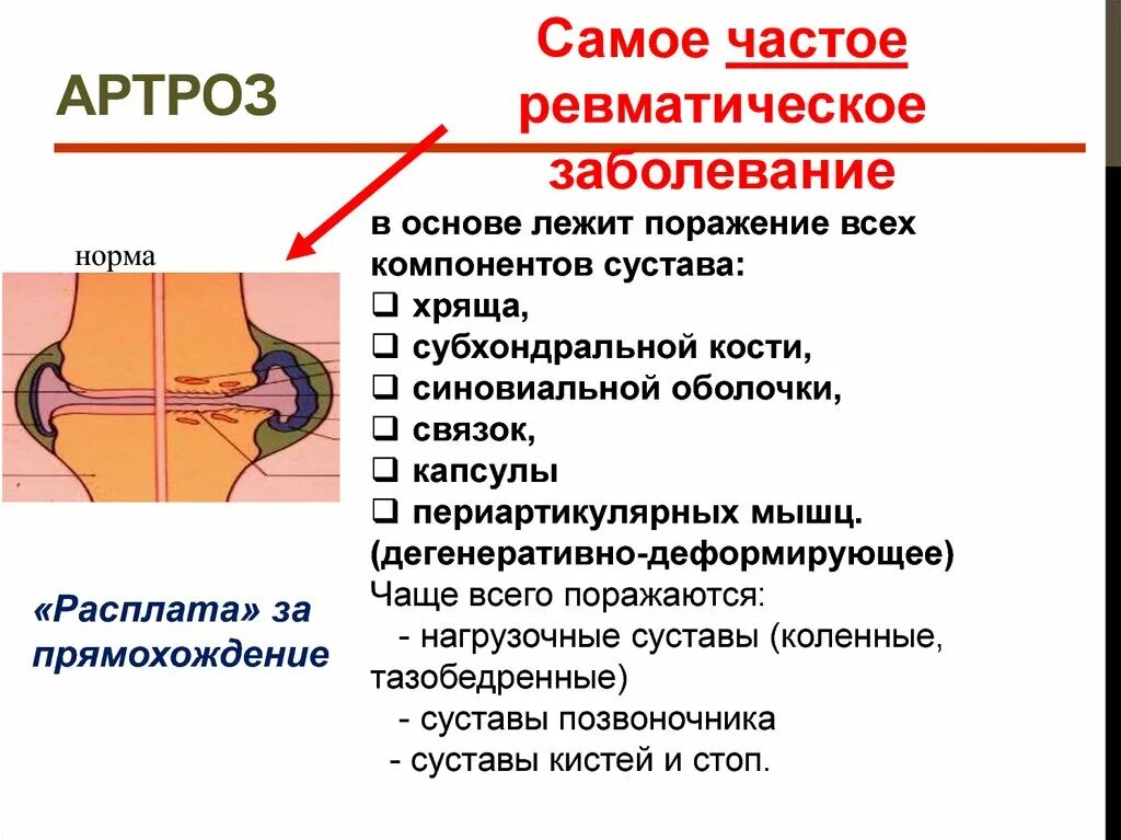 Остеоартроз коленного сустава презентация. Факторы риска артроза коленного сустава. Артрит коленных суставов код по мкб 10