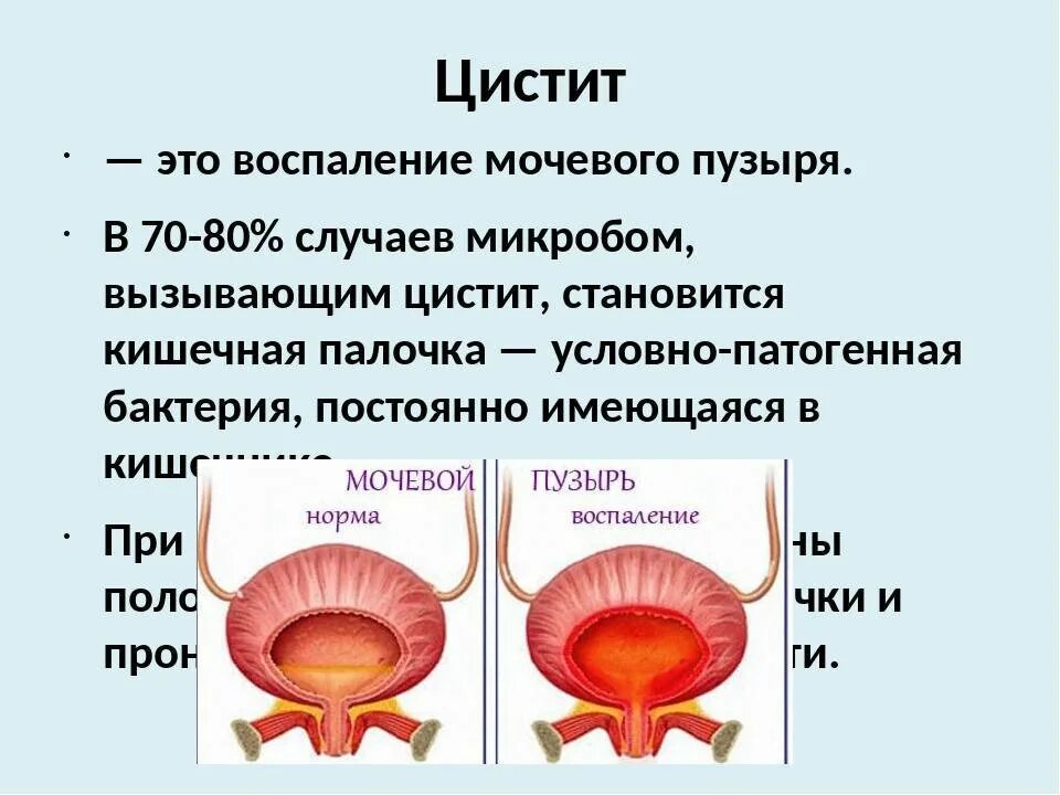 Воспаление мочевого пузыря. Цистит воспаление мочевого пузыря. Воспаление слизистой оболочки мочевого пузыря.