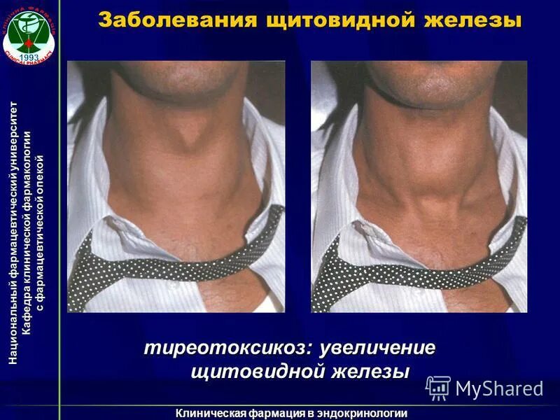 Увеличенаящитовидная железа. Расширенная щитовидная железа. Увеличенная щитовидная у мужчин.