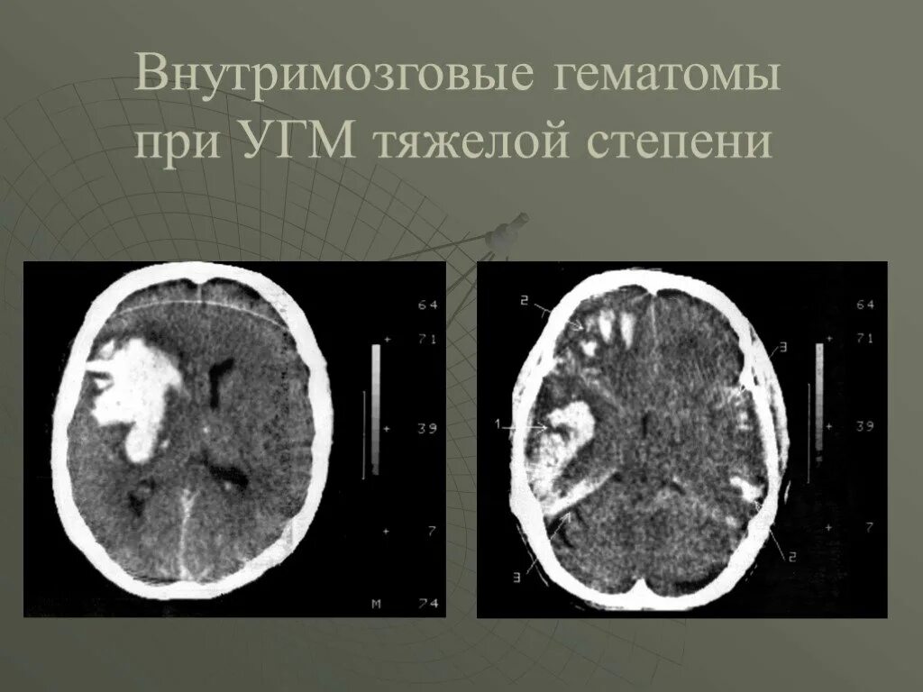 Мрт при сотрясении. Внутримозговая гематома мрт. Внутримозговая гематома кт. Ушиб головного мозга тяжелой степени кт. Кт внутримозговая гематома головного мозга.