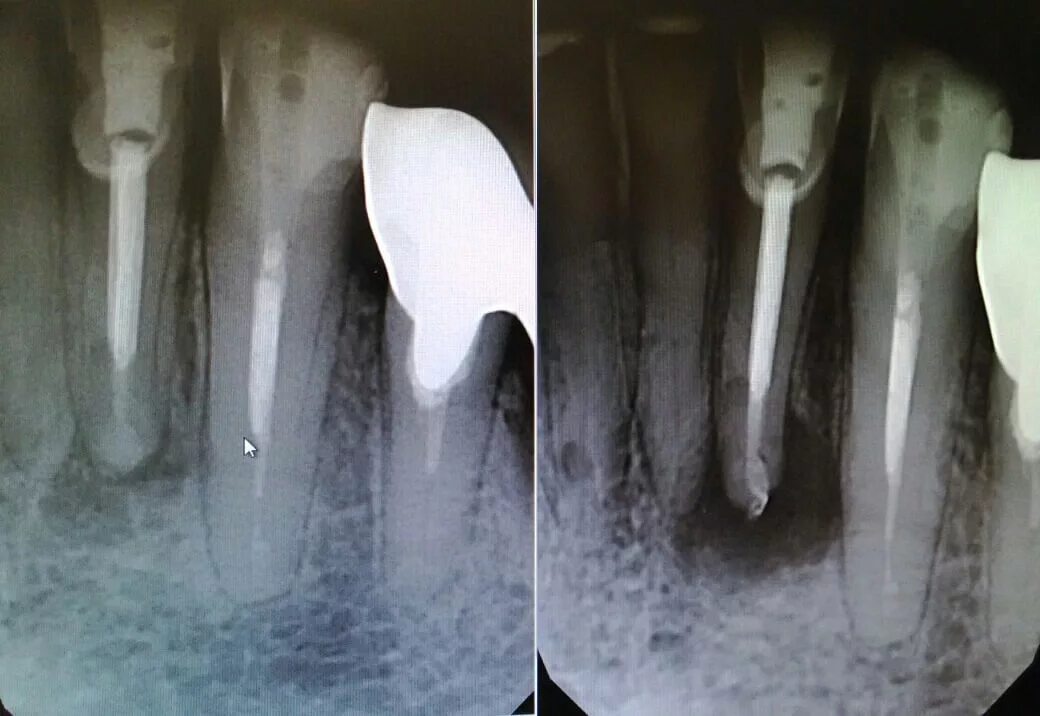 Пульпит переднего зуба рентген. Кариес корня зуба снимок. Поддесневой кариес корня.
