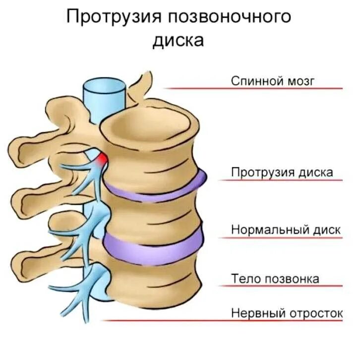 Протрузия межпозвоночного диска поясничного. Остеохондроз протрузии межпозвонковых дисков. Протрузия l5-s1. Протрузия грыжа межпозвонковых дисков. Протрузии межпозвонковых дисков грудного отдела.