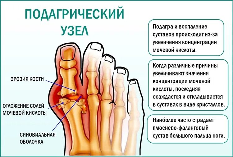 Повышенный уровень мочевой кислоты у мужчин. Подагра мочевая кислота.