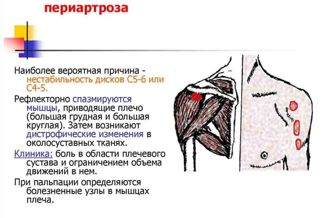 Болит левое плече у мужчины. Лопаточный периартроз плечевого сустава. Синдром плечелопаточный периартрит. Плече-лопаточный синдром. Заболевания плечевого мышц и сустава.