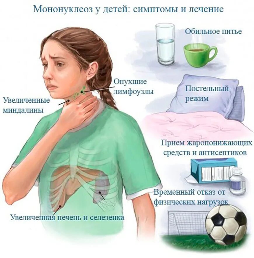 Моноклиоз. Инфекционный мононуклеоз (инфекция вирусом Эпштейна — Барра). Основные симптомы инфекционного мононуклеоза. Инфекционный мононуклеоз у детей симптомы.