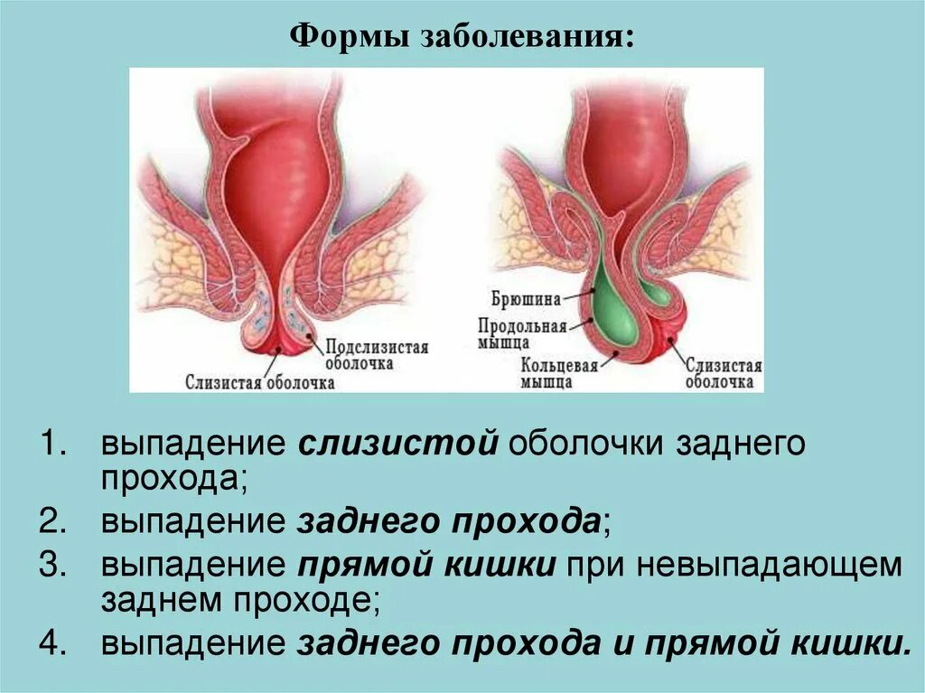 Выпадение прямой кишки причины. Геморрой выпадение прямой кишки. Выпадение прямой к шки. Выпадение прямой кишки у человека. Выпадение слизистой прямой кишки.