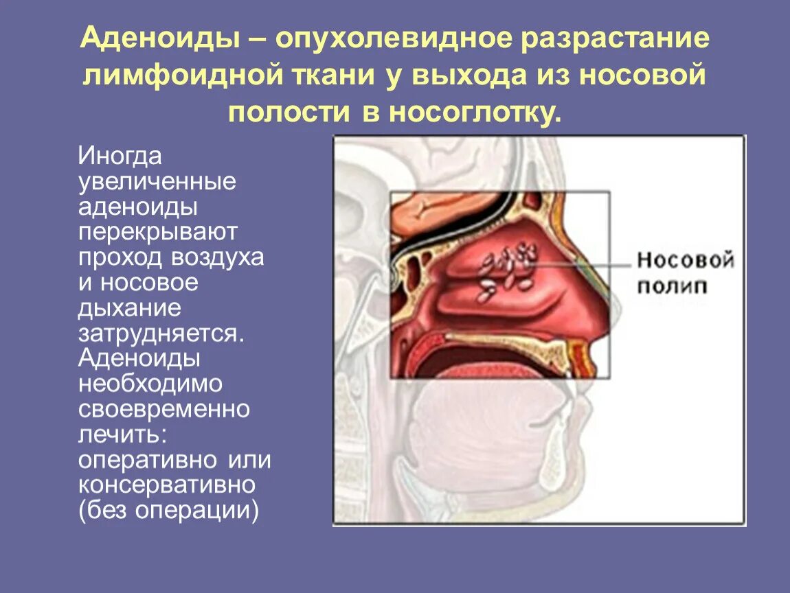 Аденоиды признаки. Аденоиды это разрастание лимфоидной ткани. Аденозид. Дейнопиды. Строение носоглотки у детей.