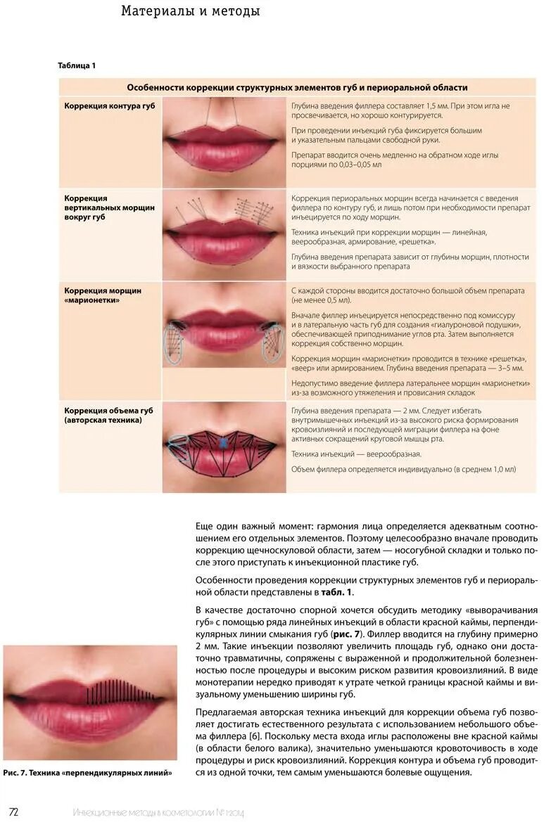 Увеличение губ гиалуроновой кислотой что нельзя. Схема уколов гиалуроновой кислоты на губах. Контурная пластика губ схемы введения. Методика введения филлера в губы.