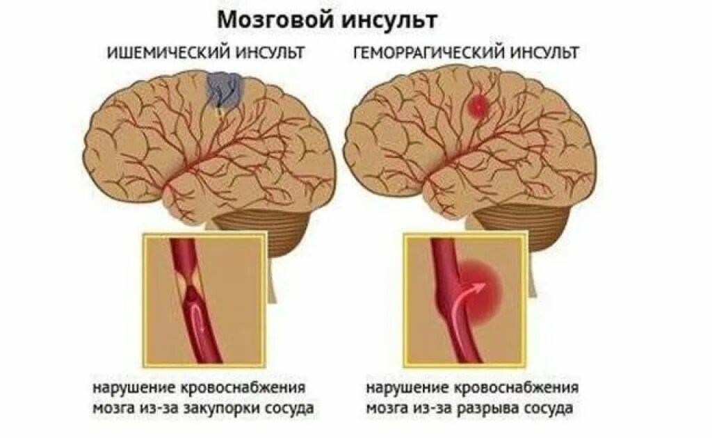 Может быть инсульт мозгов. Ишемический и геморрагический инсульт головного мозга. Закупорка сосудов головного мозга инсульт. Геморрагический инсульт головного мозга симптомы. Типы ишемического инсульта.