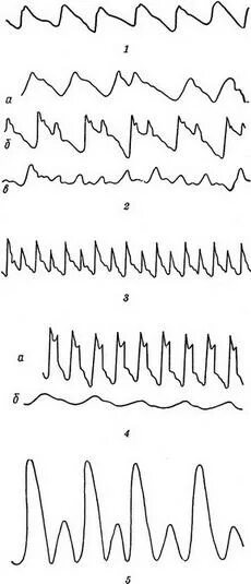 Ритмичный пульс. По амплитуде пульс бывает. Свойства артериального пульса. Ритмичный пульс. Пульс ритмичный малого наполнения и напряжения.