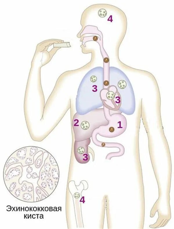 Эхинококки симптомы у людей лечение. Эхинококкоз печени патогенез. Эхинококкоз жизненный цикл. Эхинококкоз печени этиология. Эхинококкоз паразит заражение.