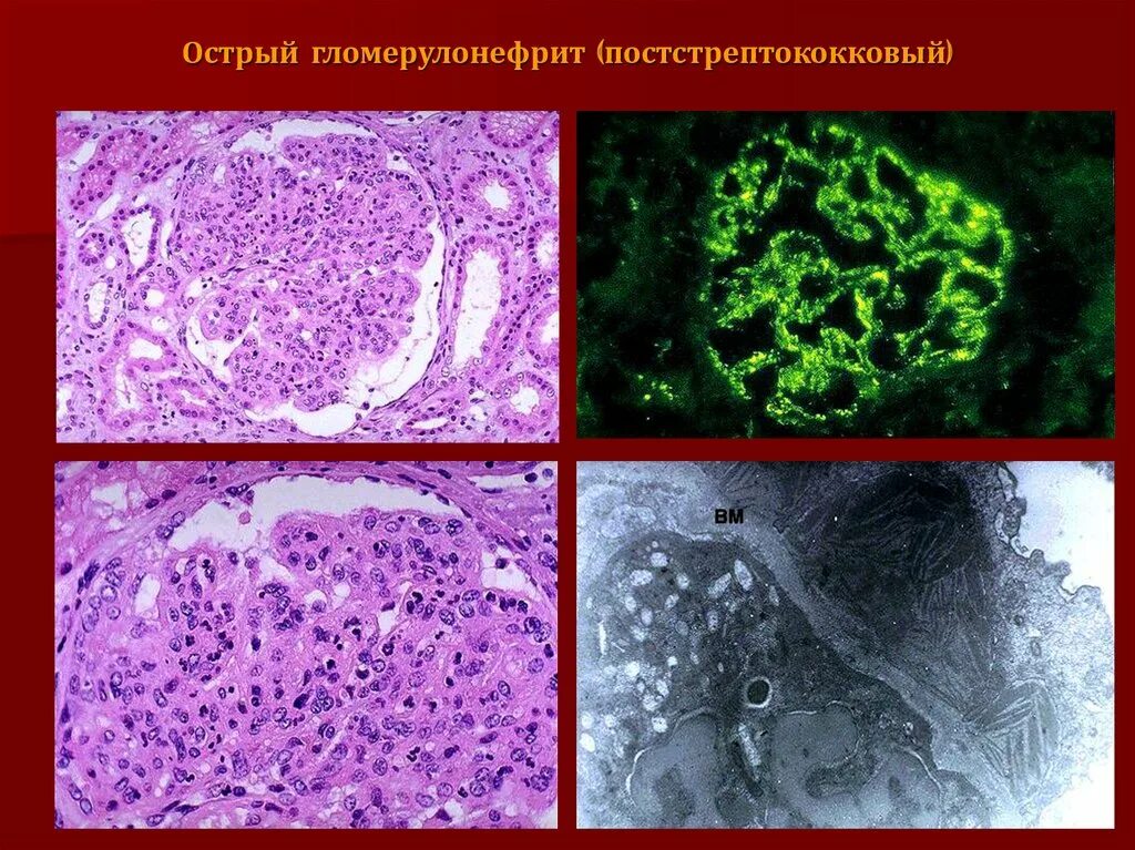 Острый гломерулонефрит после ангины. Хронический фибропластический гломерулонефрит. Постстрептококковый гломерулонефрит патанатомия. Острый постстрептококковый гломерулонефрит классификация. Фибропластический гломерулонефрит микропрепарат.