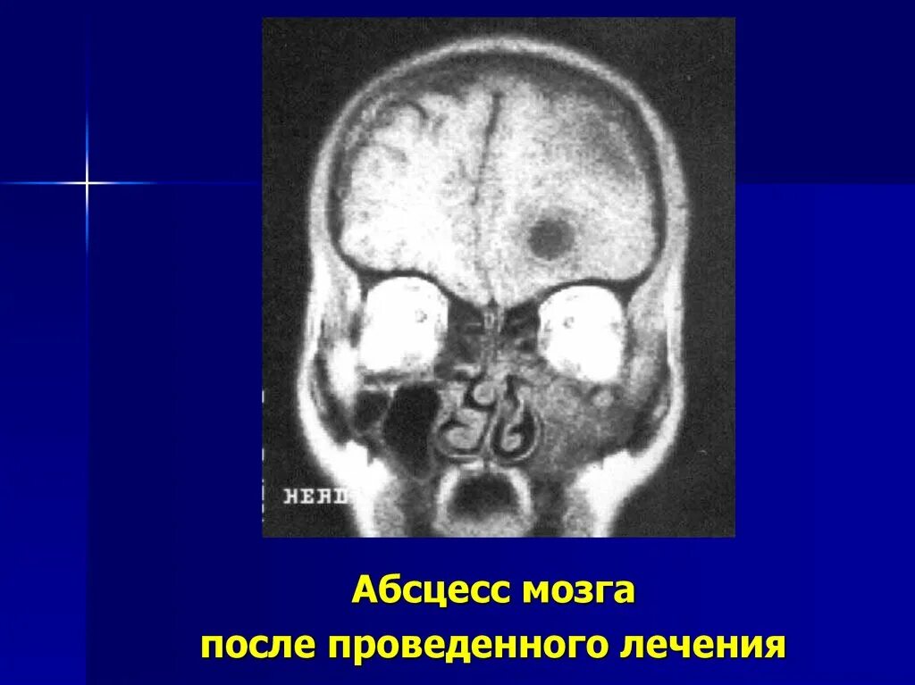 Внутричерепной абсцесс. Абсцесс мозга осложнения. Внутричерепные осложнения синусита. Риногенные внутричерепные осложнения