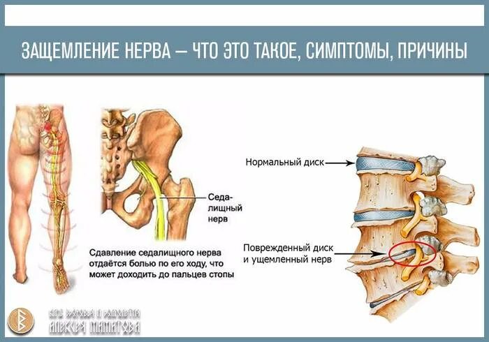 Чем лечить нерв в пояснице. Защемило нерв в пояснице. Ущемление поясничного нерва.