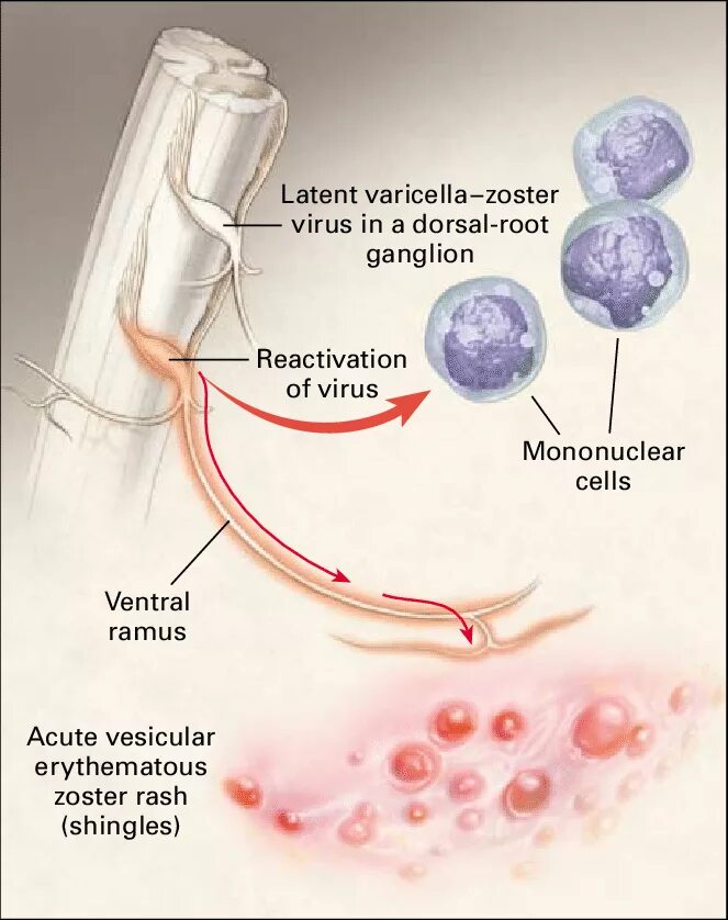 Varicella zoster virus igg. Varicella zoster семейства Herpesviridae. Вирус герпеса 3 типа varicella-zoster. Герпес Варицелла-Зостера.