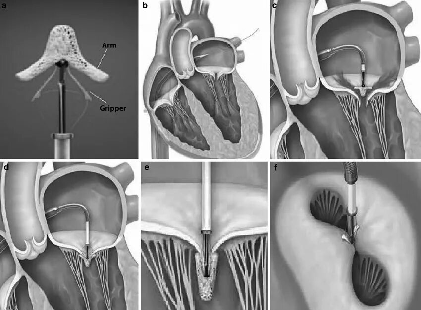 Велосипед простата. Баллонная вальвулопластика митрального клапана. Баллонная вальвулотомия митрального клапана. Клипирование митрального клапана. Эндоваскулярное клипирование митрального клапана.