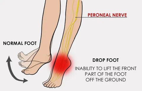 Foot drop, is a simple way to describe the loss of Range of Movement (ROM) ...