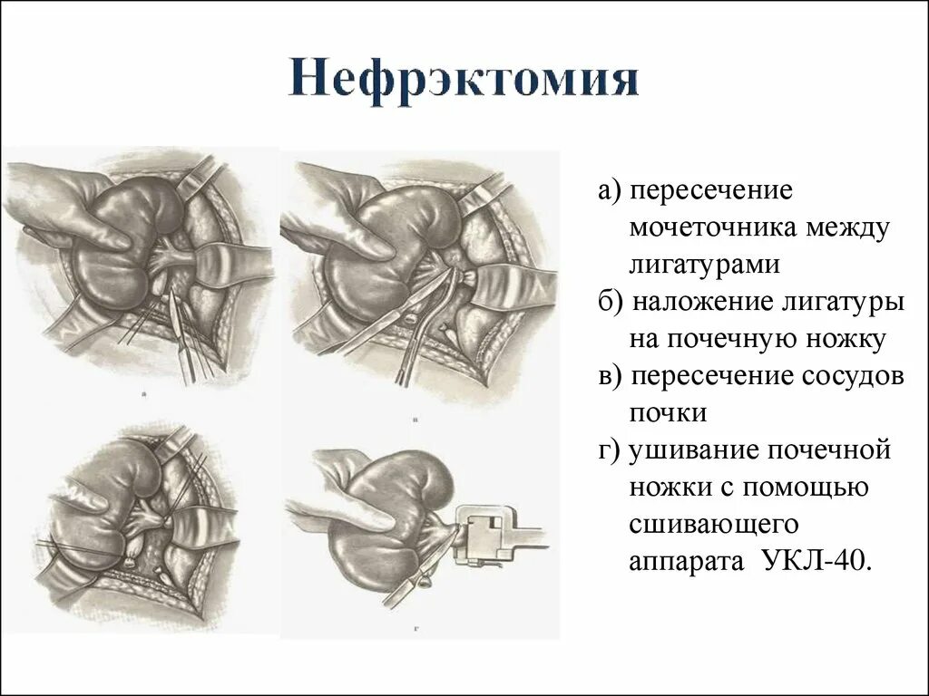 Нефрэктомия ход операции. Ход операции правосторонняя нефрэктомия. Трансперитонеальная нефрэктомия. Нефрэктомия резекция почки. Назовите этапы операции