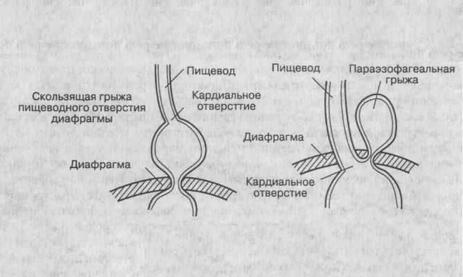 Грыжа пищевода что это симптомы и лечение. Скользящие и параэзофагеальные грыжи пищеводного отверстия. Параэзофагеальная грыжа пищеводного отверстия. Аксиальная скользящая грыжа рентген. Схема параэзофагеальной грыжи диафрагмы.