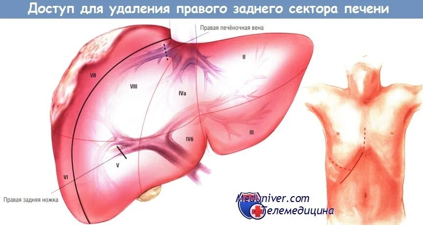 Операция по удалению печени. Сегменты печени. Сегментарная резекция печени. Плоскостная резекция печени. Резекция правой доли печени.