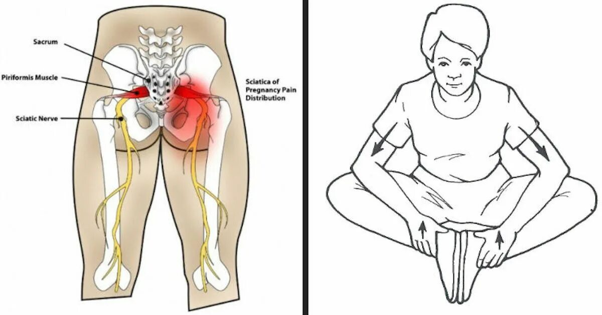 Седалищный нерв Су Джок. Седалищный нерв л5 с1. Седалищный нерв схема. Растяжка седалищного нерва. Можно делать массаж при седалищном