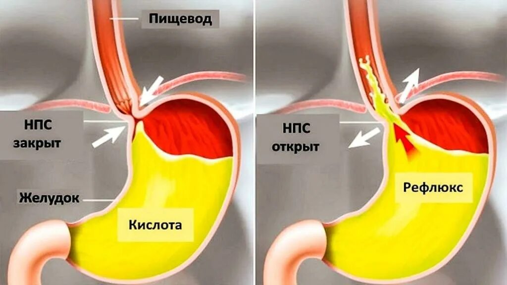 Рефлюкс типа. Сфинктер желудка и пищевода. КЛАМАН меж желудком и пищеводом.