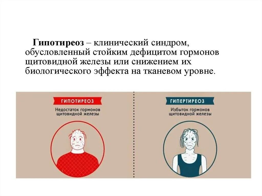 Гипотиреоз заболевание щитовидной. Гипотиреоз щитовидной железы. Проявления избытка гормона щитовидной железы. Клинические симптомы гипотиреоза. Заболевания при избытке гормонов щитовидной железы.