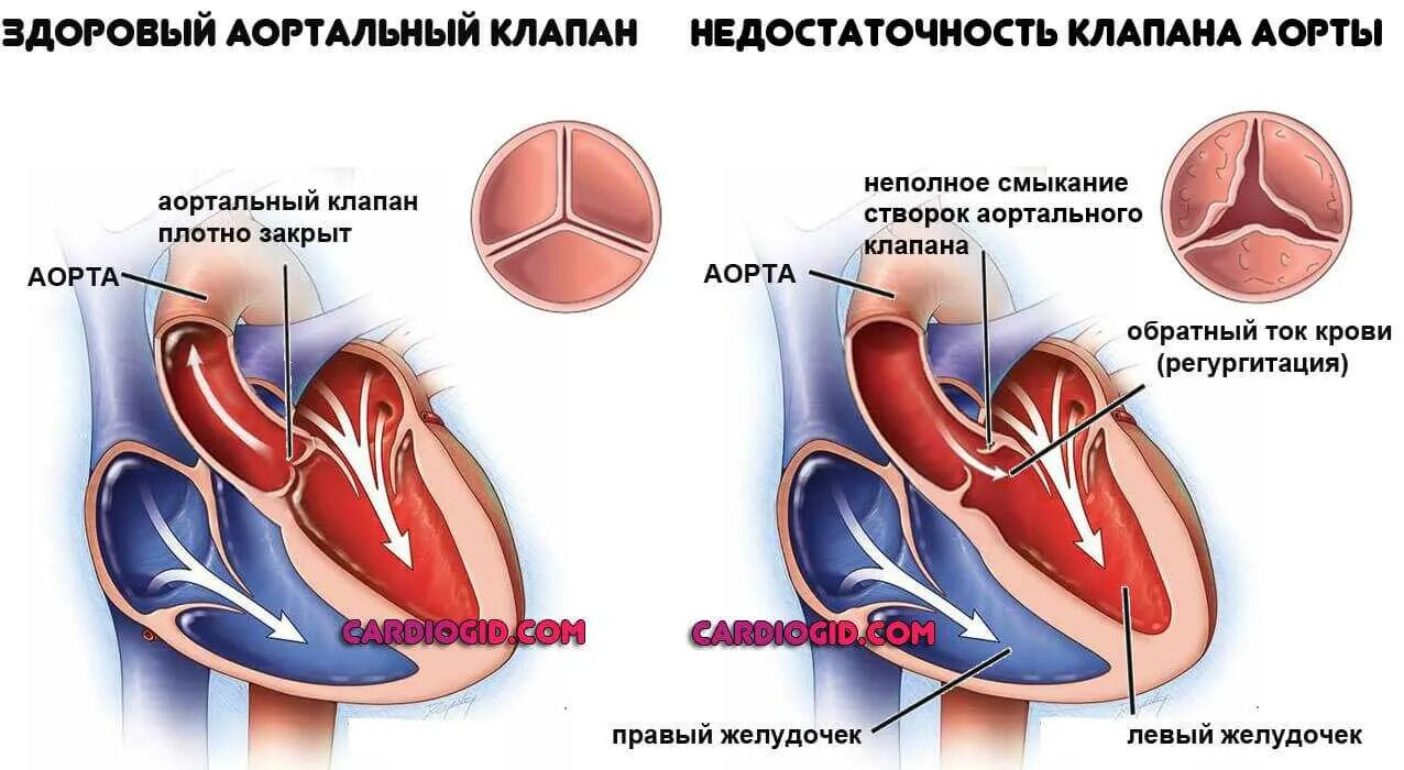 Поражение митрального клапана. Недостаточность аортального клапана рисунок. Недостаточность митрального клапана и аортального клапана. Недостаточность клапана аорты сердца. Недостаточность аортального клапана у детей гемодинамика.