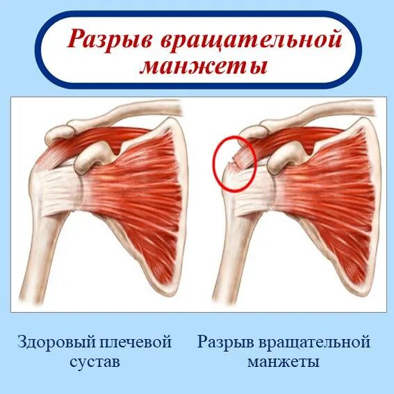 Повреждения плеча вращательной манжеты s46. Вращательная манжета плеча мышцы. Синдром вращательной манжеты плечевого плечевого сустава. Сухожилие манжета вращательной манжеты плечевого сустава.