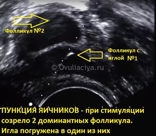 Вздутие после овуляции. Состояние яичников после стимуляции овуляции. После овуляции есть доминантный фолликул. Доминантный фолликул 20 мм.